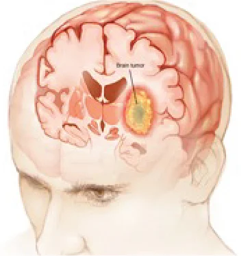 Brain Cancer: Its Causes, Symptoms, and Treatment